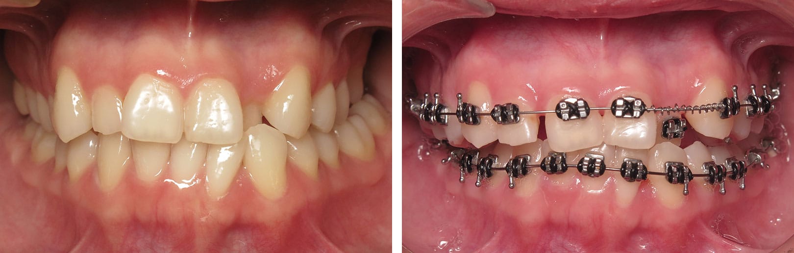 Adult Expanders in Puyallup & Graham, WA Smiles Orthodontics
