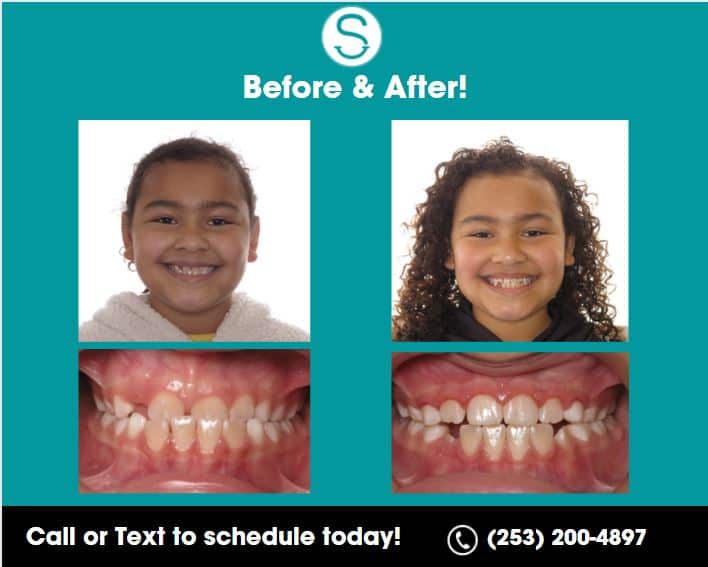 Underbite in Puyallup & Graham, WA Smiles Orthodontics
