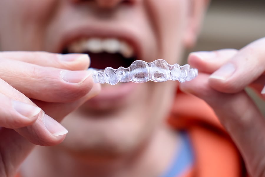 Can Invisalign Clear Aligners Fix an Overbite