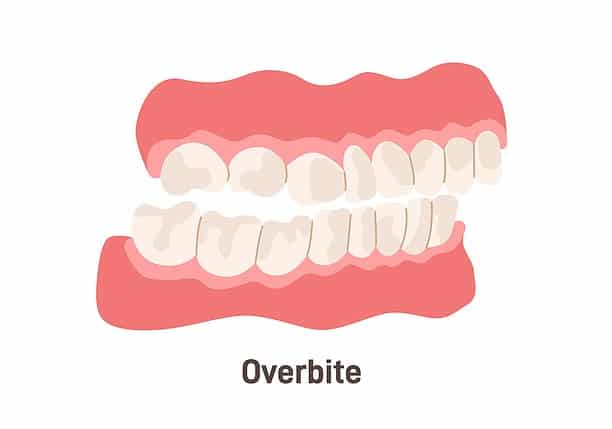 Can Invisalign Fix Overbite A Comprehensive Guide To Treatment