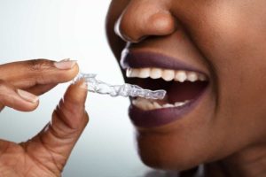 Invisalign Misconceptions: Debunking Common Clear Aligner Myths