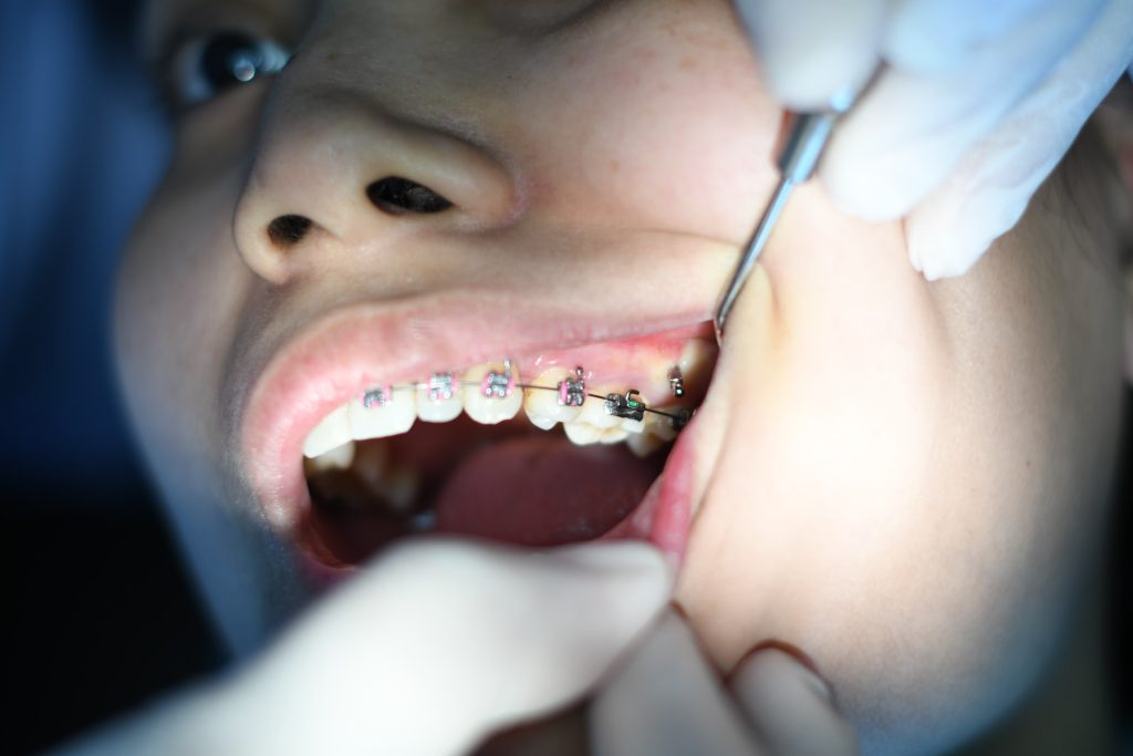 Braces Guide: Essential Tips for a Successful Orthodontic Journey