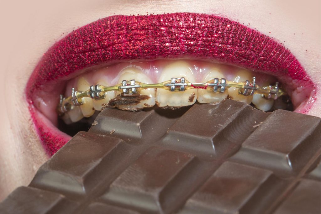 Foods to Avoid Wearing Braces: Expert Advice for Better Results