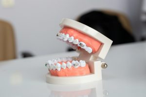 Braces on a Budget: Smart Ways to Get the Smile You Deserve