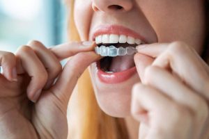 Does Invisalign affect your face
