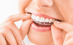 Invisalign and facial structure