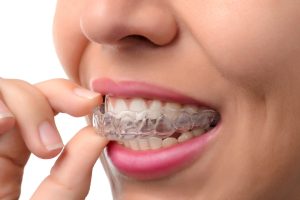 Patient wearing Invisalign aligners during treatment process
