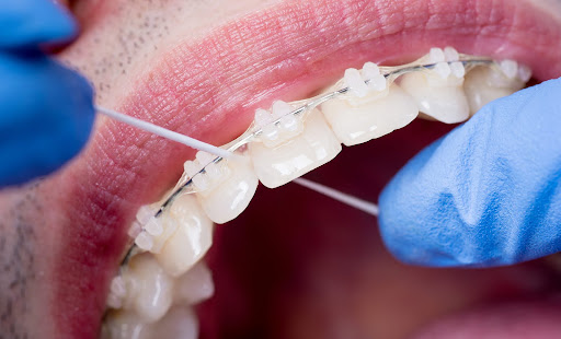 Tools used for effective smile care with braces