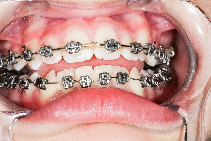 close-up of braces and gumline during orthodontic treatment in Graham WA