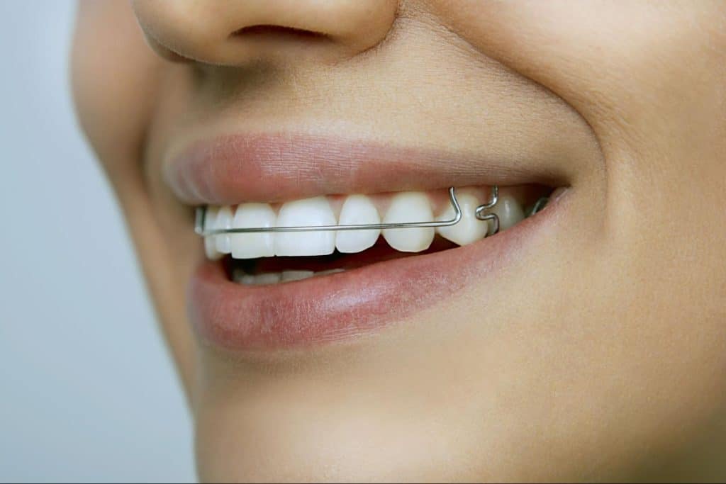 patient wearing hawley retainer