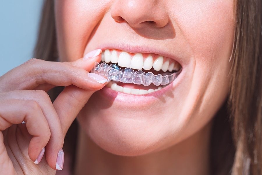 teen wearing clear aligners near Federal Way