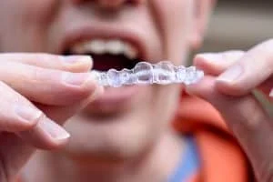 Can Invisalign fix crossbite